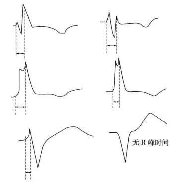 心电图纸怎么看心电图纸上跳动的线条，你了解多少？_https://www.jmylbn.com_新闻资讯_第9张