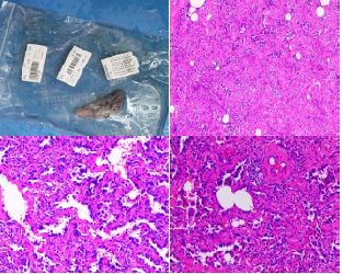 肺结节分叶状有毛刺_肺结节10个人9个人有吗_100个人有多少个有肺结节