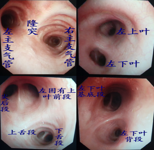 气管镜图谱各段辨认图片