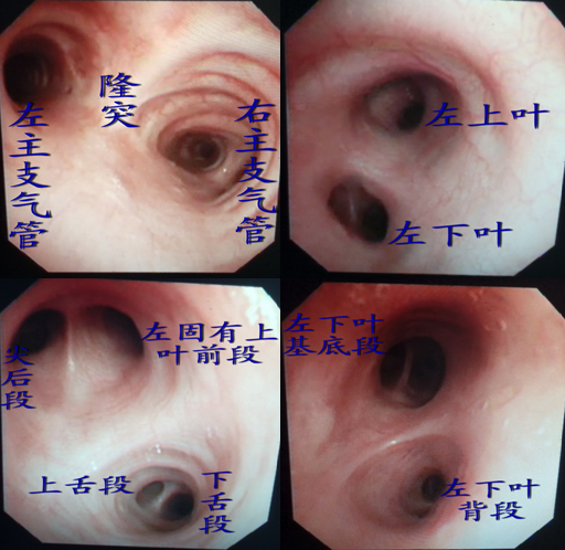 图4-6 后位直视下支气管树图气管在隆突处分为左右支气管(一级支气管)