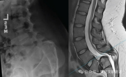 重度腰椎滑脱的手术技巧
