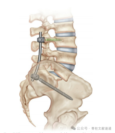 重度腰椎滑脱的手术技巧