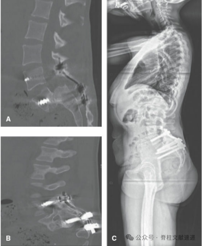 重度腰椎滑脱的手术技巧