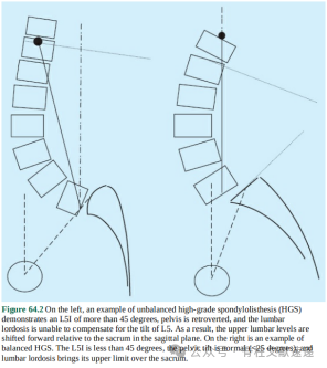 重度腰椎滑脱的手术技巧