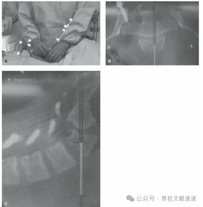 重度腰椎滑脱的手术技巧