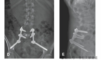 重度腰椎滑脱的手术技巧