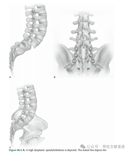 重度腰椎滑脱的手术技巧