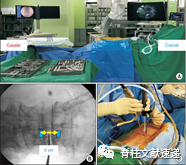 单侧双通道脊柱内镜技术（UBE/BESS），手把手教程！