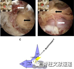 单侧双通道脊柱内镜技术（UBE/BESS），手把手教程！