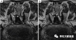 单侧双通道脊柱内镜技术（UBE/BESS），手把手教程！