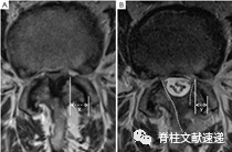 单侧双通道脊柱内镜技术（UBE/BESS），手把手教程！