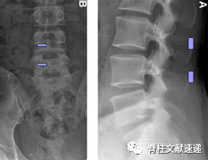 单侧双通道脊柱内镜技术（UBE/BESS），手把手教程！
