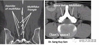 单侧双通道脊柱内镜技术（UBE/BESS），手把手教程！