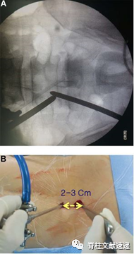 单侧双通道脊柱内镜技术（UBE/BESS），手把手教程！
