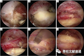 单侧双通道脊柱内镜技术（UBE/BESS），手把手教程！