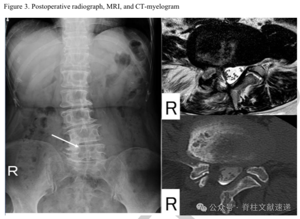 腰椎髓核摘除术的再手术率
