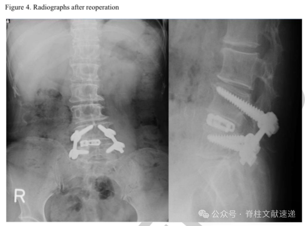 腰椎髓核摘除术的再手术率