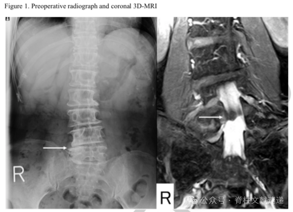 腰椎髓核摘除术的再手术率