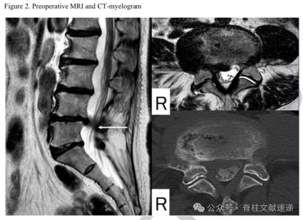 腰椎髓核摘除术的再手术率