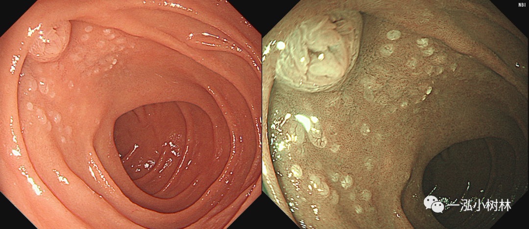 十二指肠病变放大内镜诊断(下)