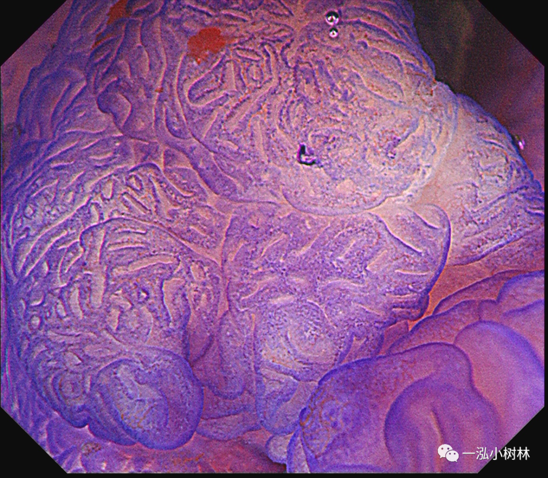 内镜图片集锦(2022年1月23)_医学界-助力医生临床决策和职业成长