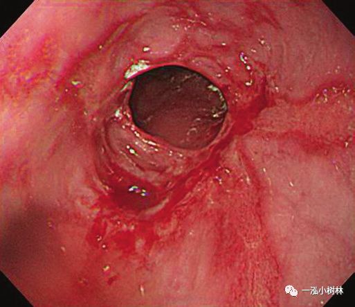 反流性食管炎barretts食管及腺癌的内镜表现