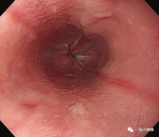 反流性食管炎barretts食管及腺癌的内镜表现