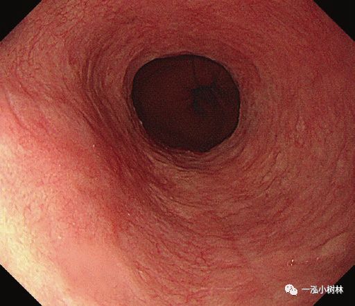 反流性食管炎barretts食管及腺癌的内镜表现
