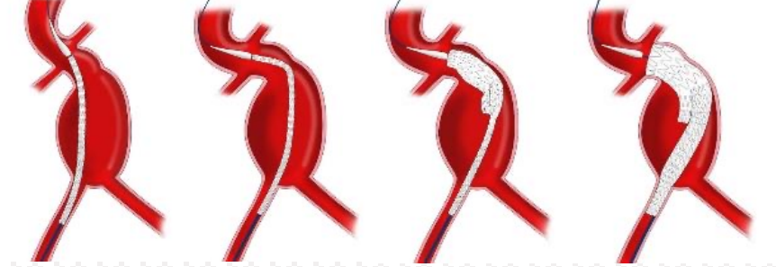 excel支架怎么样VEITH 2024｜GORE®主动脉疾病全腔内修复解决方案最新进展_https://www.jmylbn.com_新闻资讯_第6张