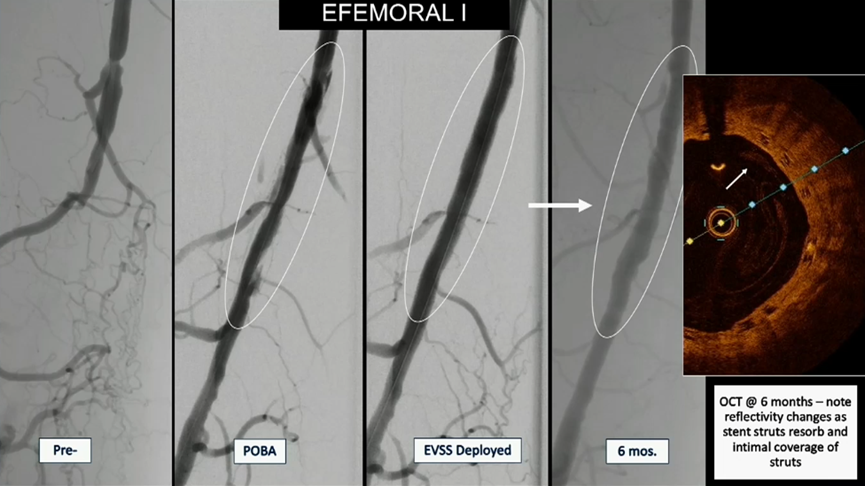什么是外周支架CX 2023 BVS／DRS专题｜Efemoral Ⅰ研究更新——西罗莫司涂层球扩式生物可吸收支架用于股腘动脉疾病_https://www.jmylbn.com_新闻资讯_第9张