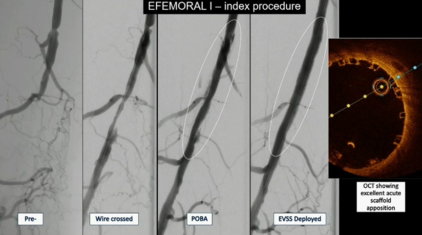 什么是外周支架CX 2023 BVS／DRS专题｜Efemoral Ⅰ研究更新——西罗莫司涂层球扩式生物可吸收支架用于股腘动脉疾病_https://www.jmylbn.com_新闻资讯_第8张