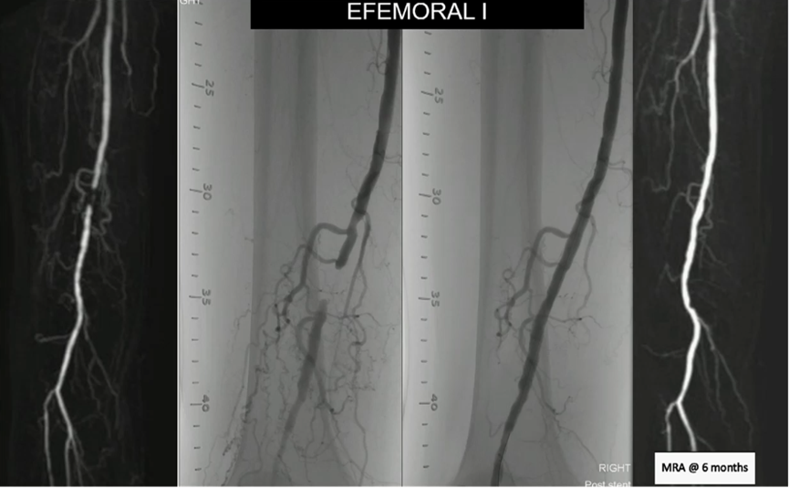 什么是外周支架CX 2023 BVS／DRS专题｜Efemoral Ⅰ研究更新——西罗莫司涂层球扩式生物可吸收支架用于股腘动脉疾病_https://www.jmylbn.com_新闻资讯_第10张