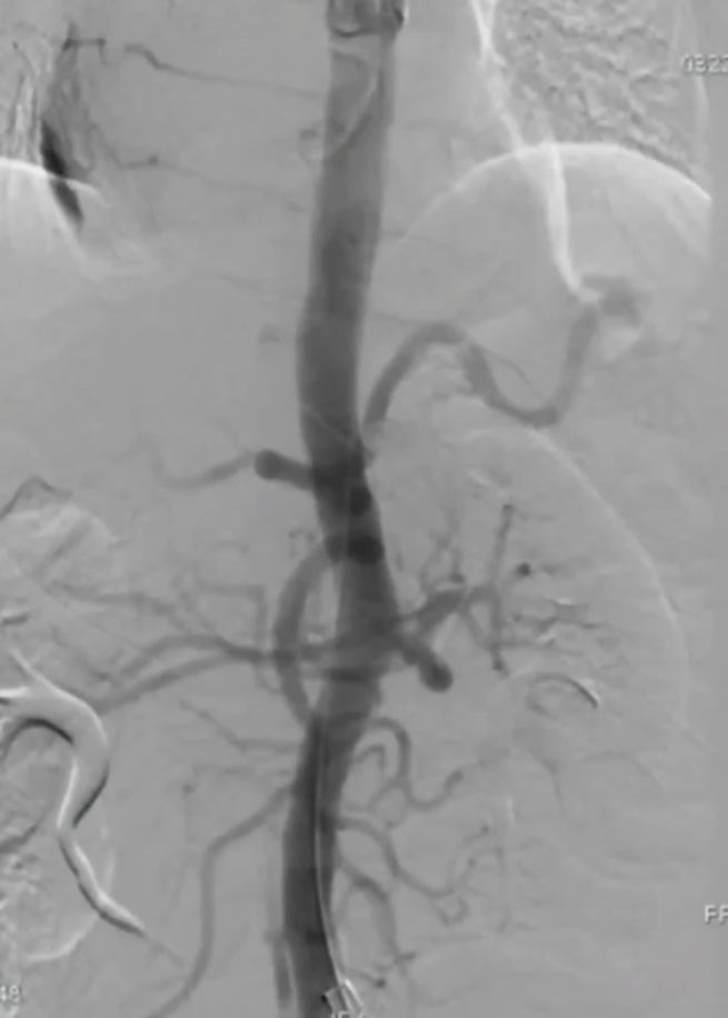 波科支架怎么样陆信武：激光原位开窗重建弓上分支治疗A型主动脉夹层_https://www.jmylbn.com_新闻资讯_第10张