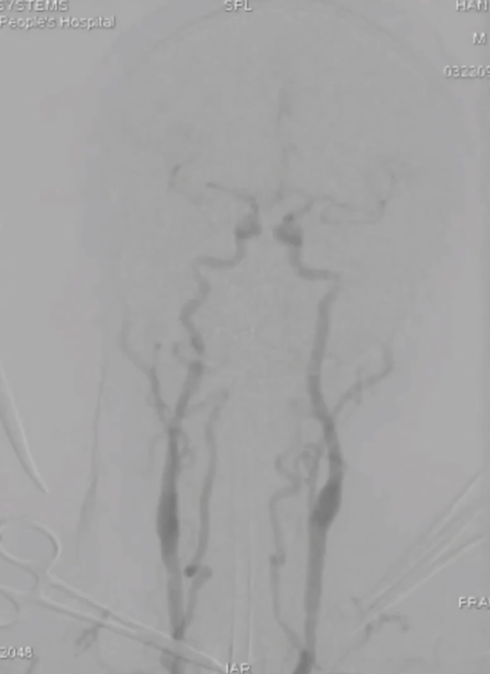 波科支架怎么样陆信武：激光原位开窗重建弓上分支治疗A型主动脉夹层_https://www.jmylbn.com_新闻资讯_第11张