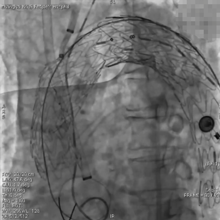 波科支架怎么样陆信武：激光原位开窗重建弓上分支治疗A型主动脉夹层_https://www.jmylbn.com_新闻资讯_第5张