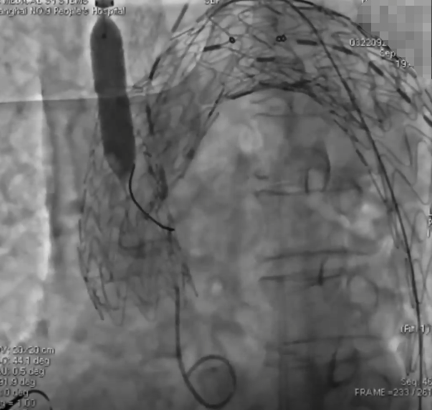 波科支架怎么样陆信武：激光原位开窗重建弓上分支治疗A型主动脉夹层_https://www.jmylbn.com_新闻资讯_第7张