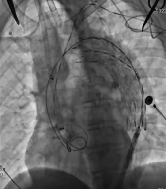波科支架怎么样陆信武：激光原位开窗重建弓上分支治疗A型主动脉夹层_https://www.jmylbn.com_新闻资讯_第4张