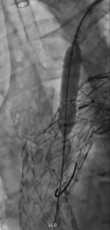 波科支架怎么样陆信武：激光原位开窗重建弓上分支治疗A型主动脉夹层_https://www.jmylbn.com_新闻资讯_第8张