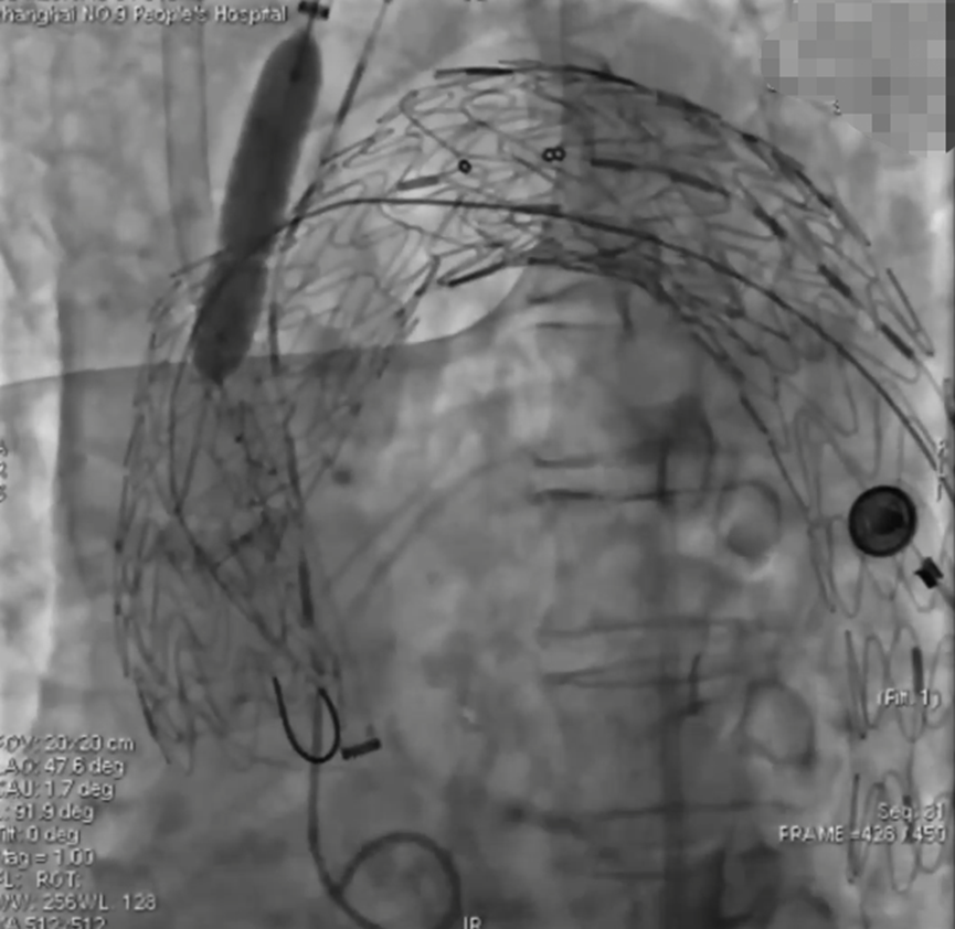 波科支架怎么样陆信武：激光原位开窗重建弓上分支治疗A型主动脉夹层_https://www.jmylbn.com_新闻资讯_第6张