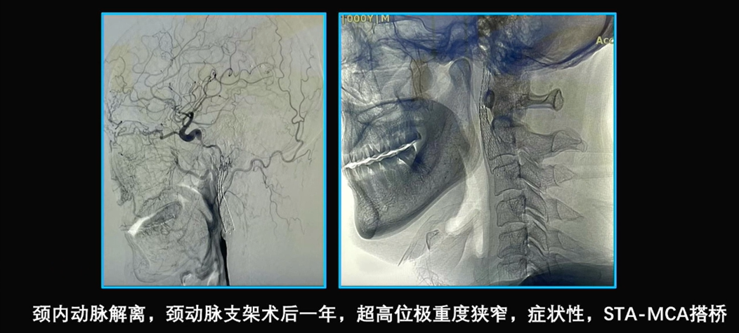 为什么手术会用到结扎夹佟志勇：高位CEA手术要点_https://www.jmylbn.com_新闻资讯_第21张