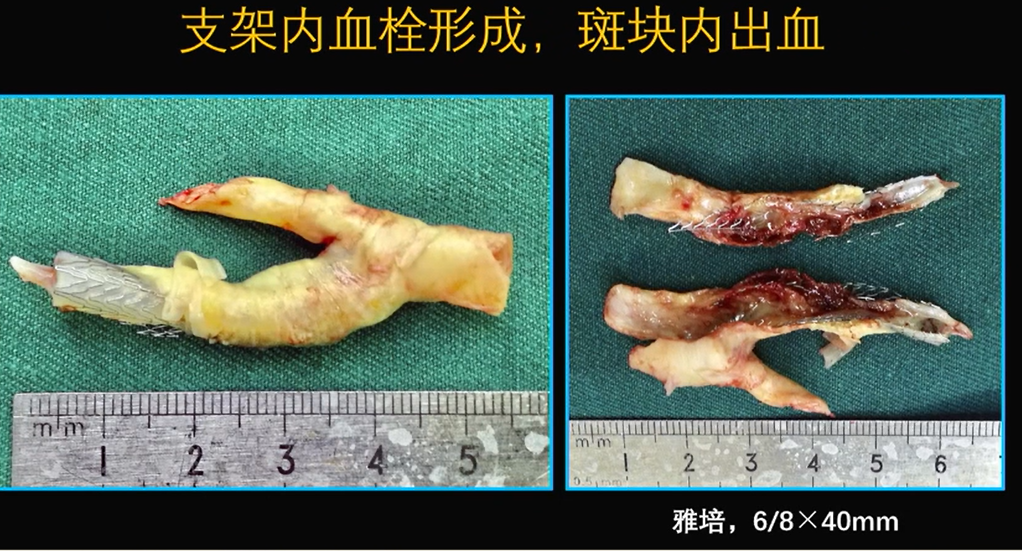 为什么手术会用到结扎夹佟志勇：高位CEA手术要点_https://www.jmylbn.com_新闻资讯_第11张