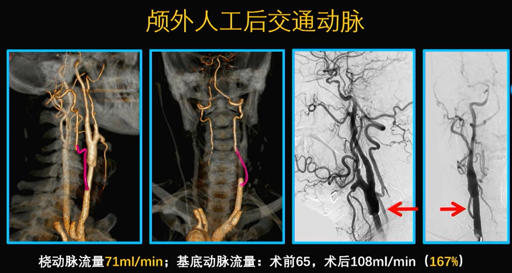 为什么手术会用到结扎夹佟志勇：高位CEA手术要点_https://www.jmylbn.com_新闻资讯_第20张