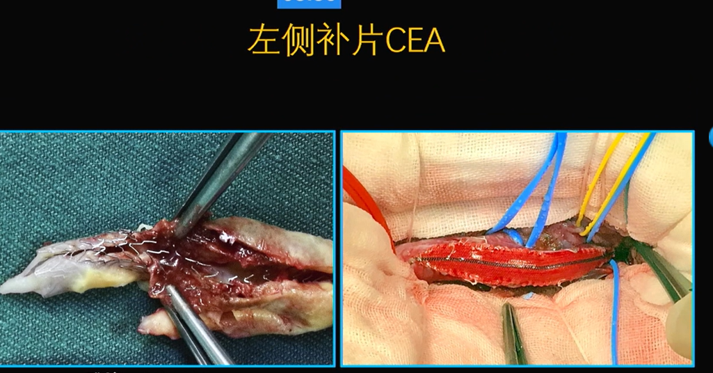 为什么手术会用到结扎夹佟志勇：高位CEA手术要点_https://www.jmylbn.com_新闻资讯_第12张