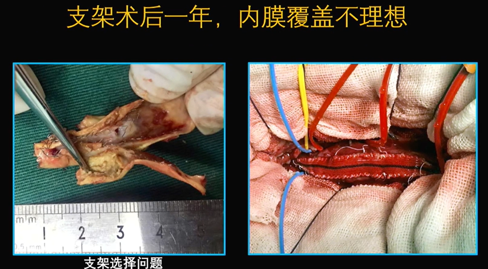 为什么手术会用到结扎夹佟志勇：高位CEA手术要点_https://www.jmylbn.com_新闻资讯_第13张