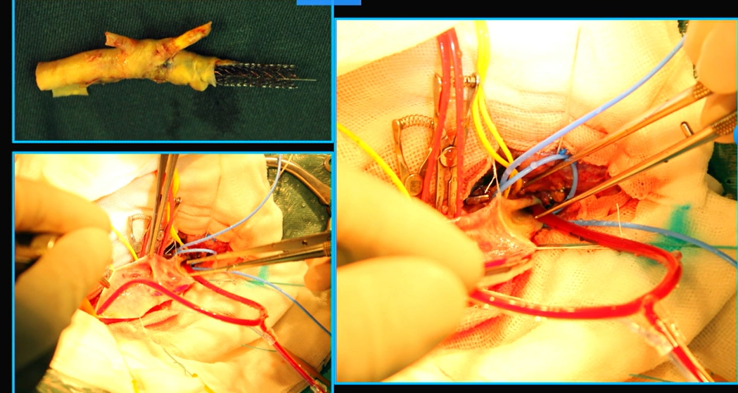 为什么手术会用到结扎夹佟志勇：高位CEA手术要点_https://www.jmylbn.com_新闻资讯_第7张