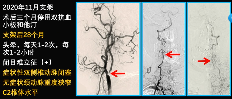 为什么手术会用到结扎夹佟志勇：高位CEA手术要点_https://www.jmylbn.com_新闻资讯_第15张