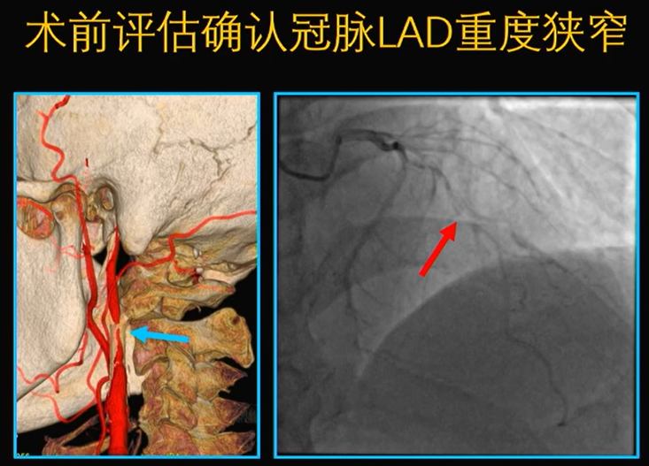 为什么手术会用到结扎夹佟志勇：高位CEA手术要点_https://www.jmylbn.com_新闻资讯_第4张