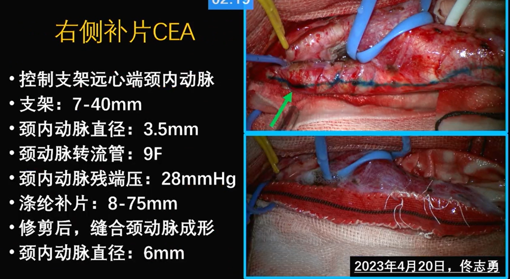 为什么手术会用到结扎夹佟志勇：高位CEA手术要点_https://www.jmylbn.com_新闻资讯_第18张