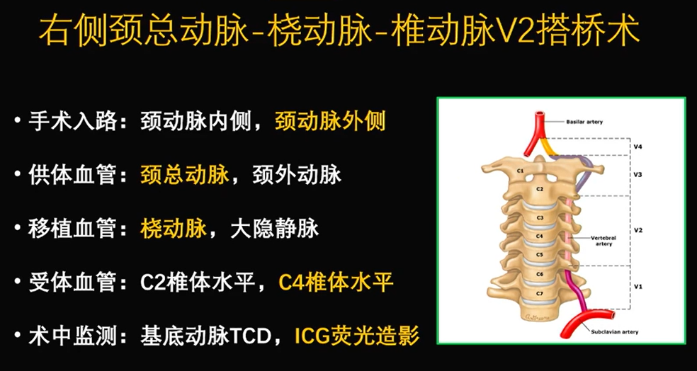 为什么手术会用到结扎夹佟志勇：高位CEA手术要点_https://www.jmylbn.com_新闻资讯_第19张