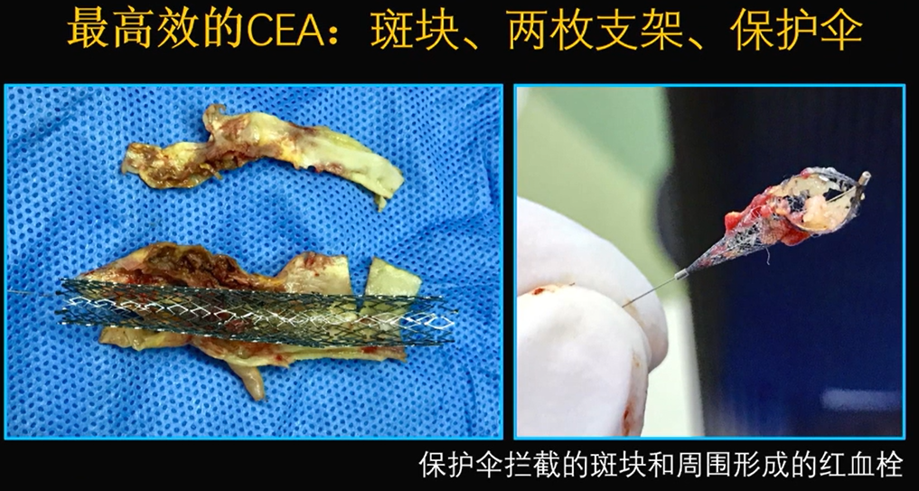 为什么手术会用到结扎夹佟志勇：高位CEA手术要点_https://www.jmylbn.com_新闻资讯_第8张